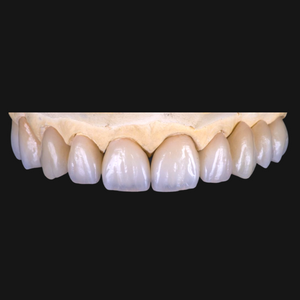 Upper set of crown and bridge teeth implants.